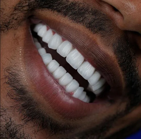 Scalp Micropigmentation (SMP) at Texture Barbershop — Specialty